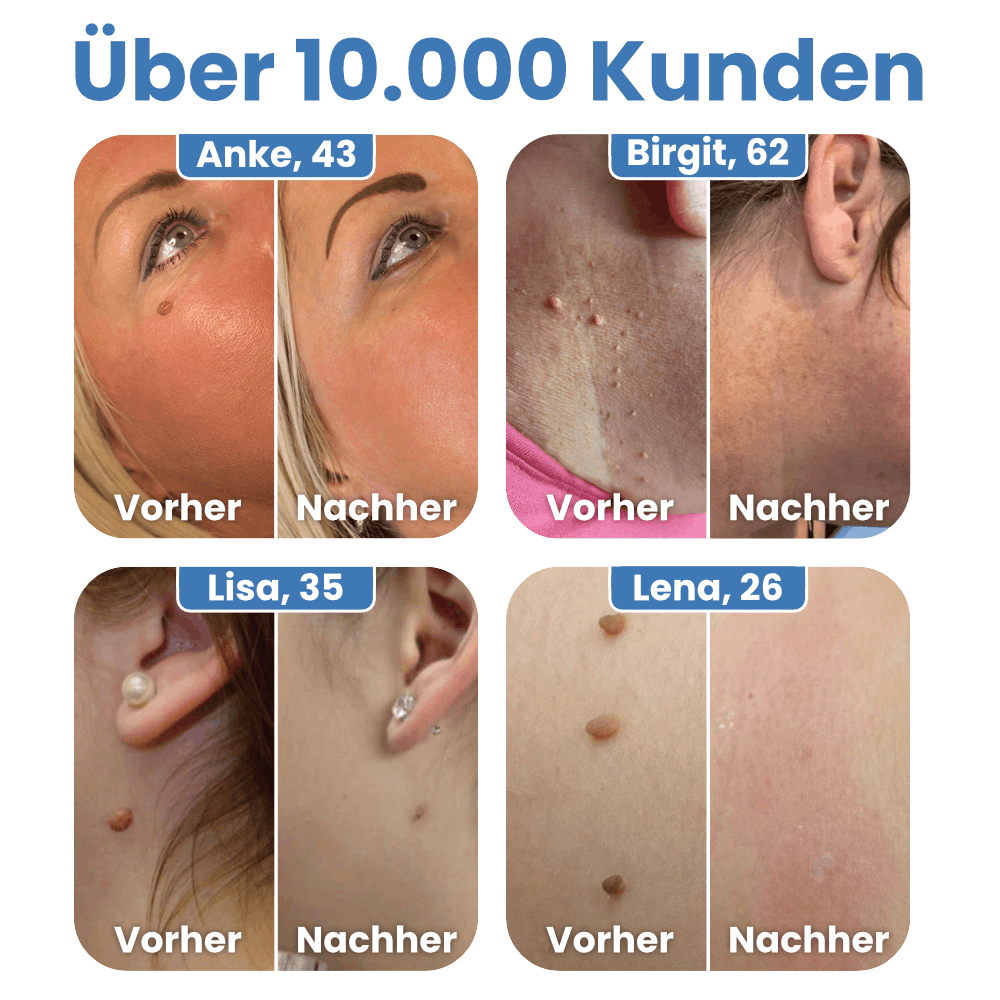 Warzenfrei - Der Stielwarzen Entferner