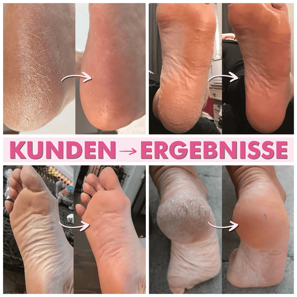 Hornhautfrei PRO - Der Professionelle Hornhaut Entferner