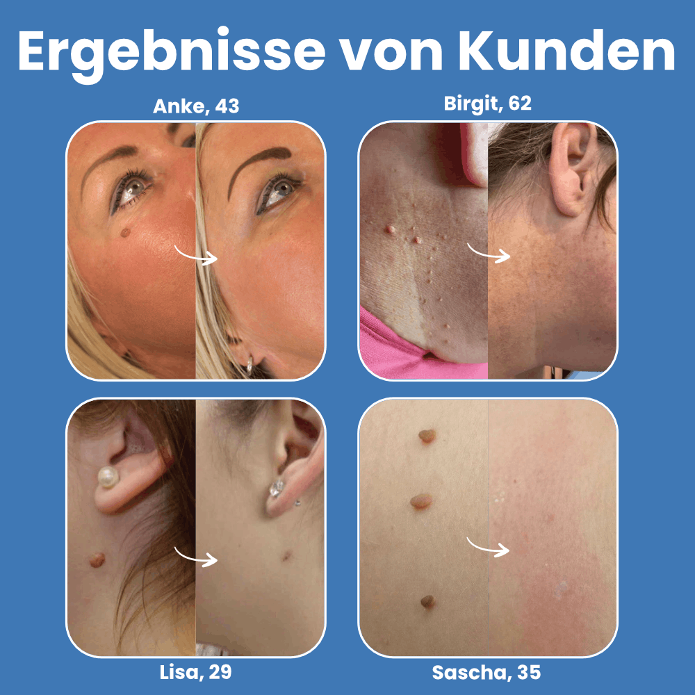 Warzenfrei - Der Stielwarzen Entferner