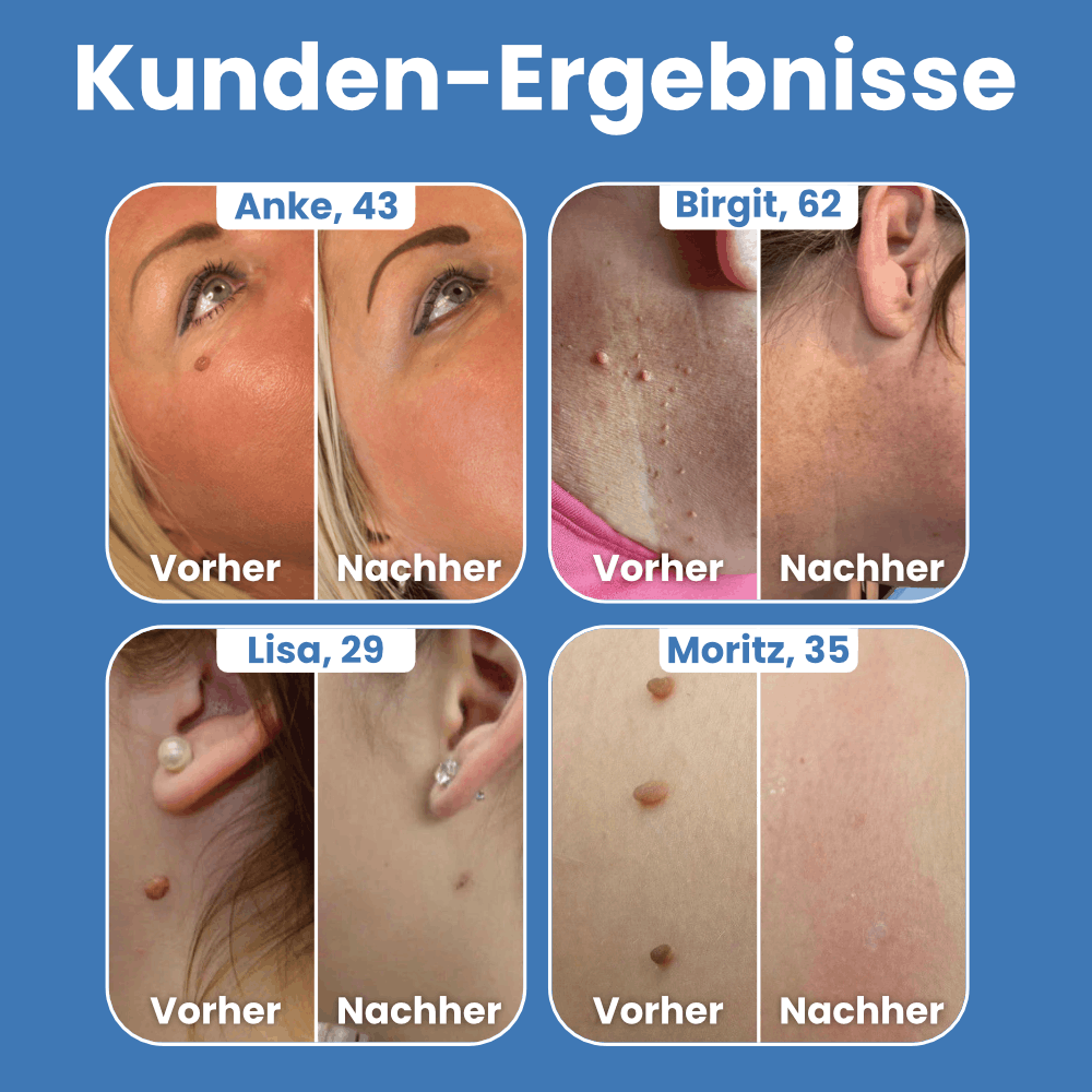 Warzenfrei - Der Stielwarzen Entferner