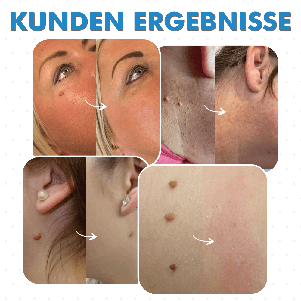 Warzenfrei - Der Stielwarzen Entferner