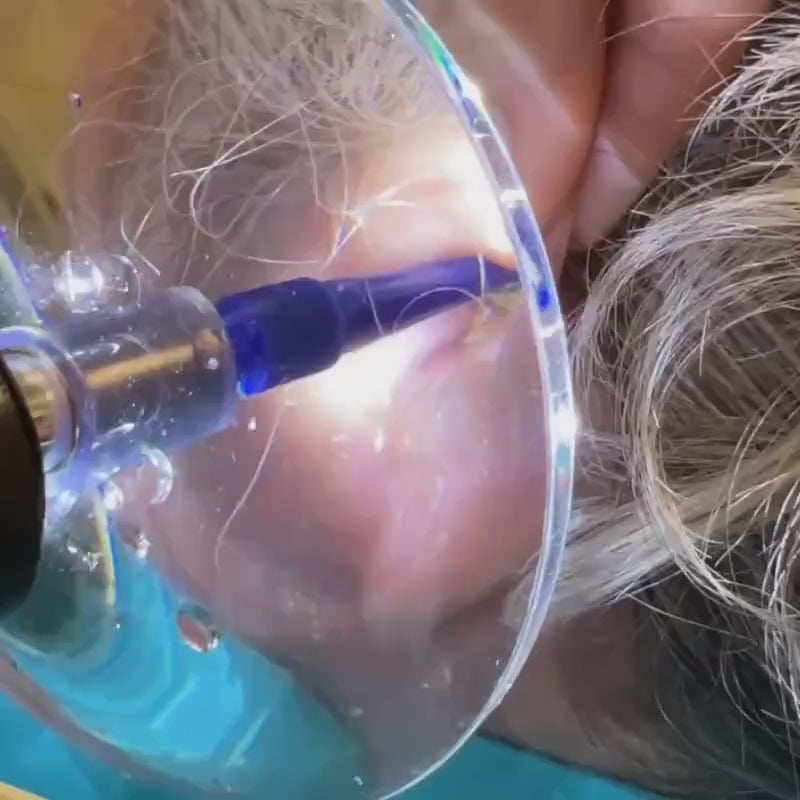 Video laden: Ohrendusche - Der Ohrenschmalz Entferner