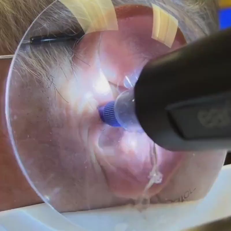 Video laden: Ohrendusche PRO - Der Professionelle Ohrenschmalz Entferner