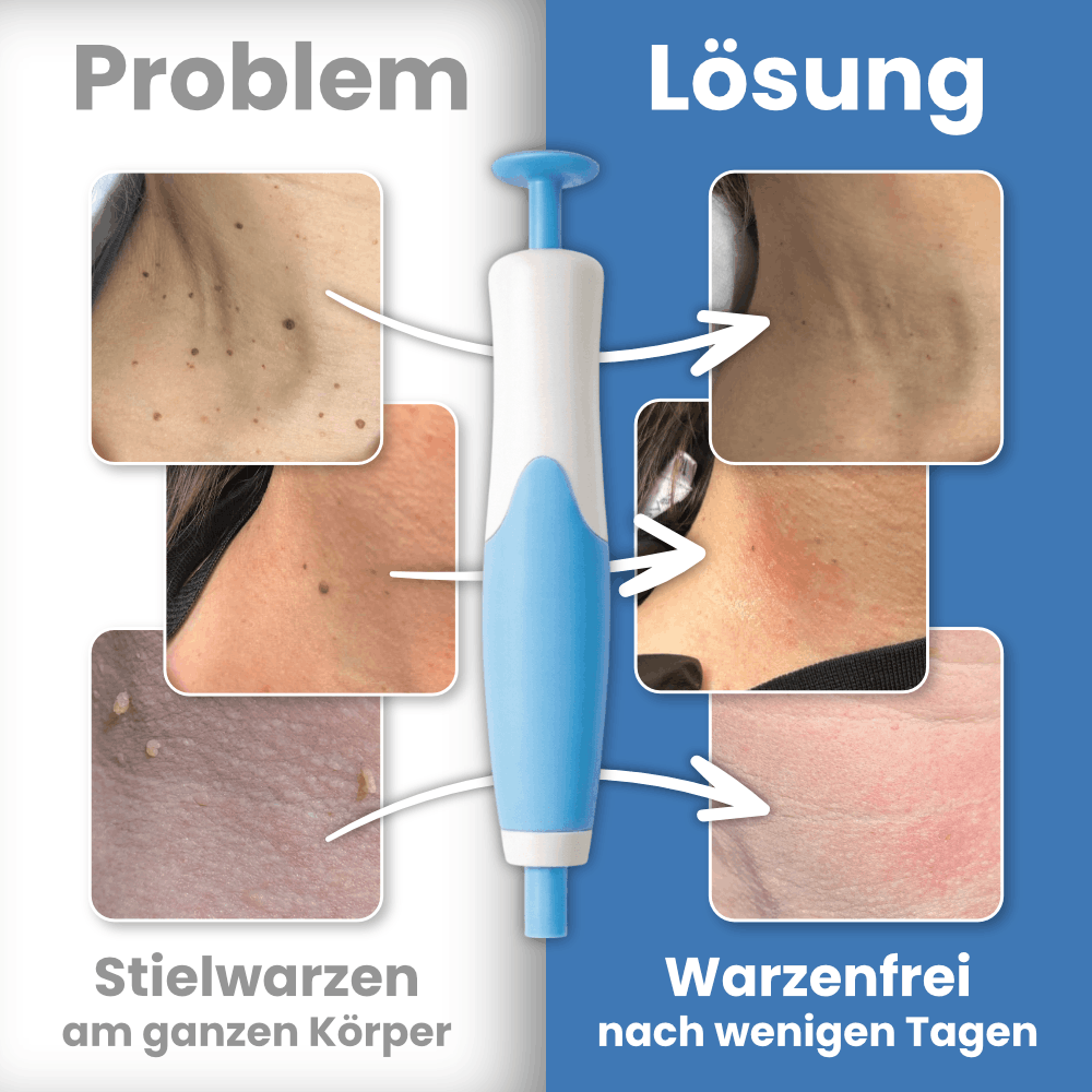 Warzenfrei - Der Stielwarzen Entferner
