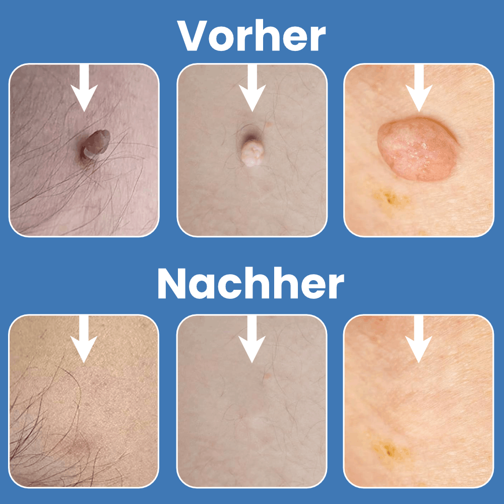 Warzenfrei - Der Stielwarzen Entferner