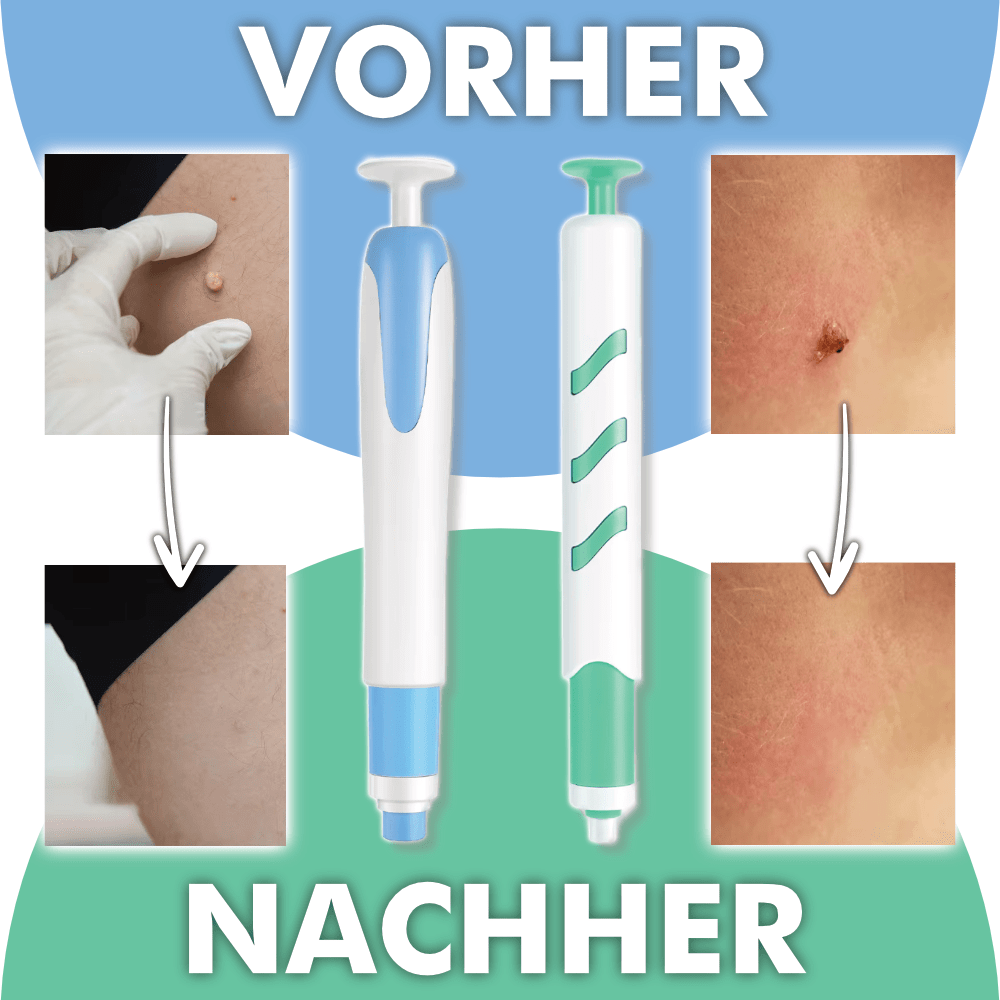 Warzenfrei PRO - Der Professionelle Stielwarzen Entferner