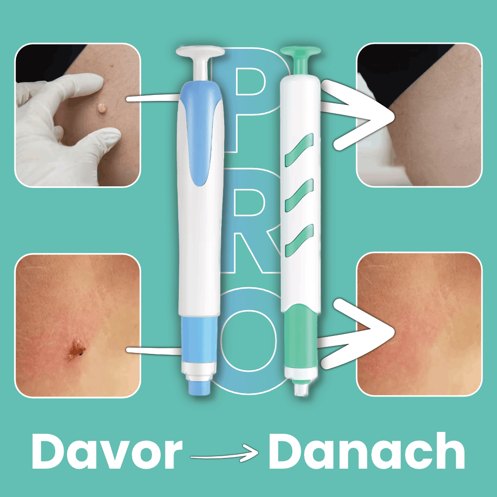 Warzenfrei PRO - Der Professionelle Stielwarzen Entferner