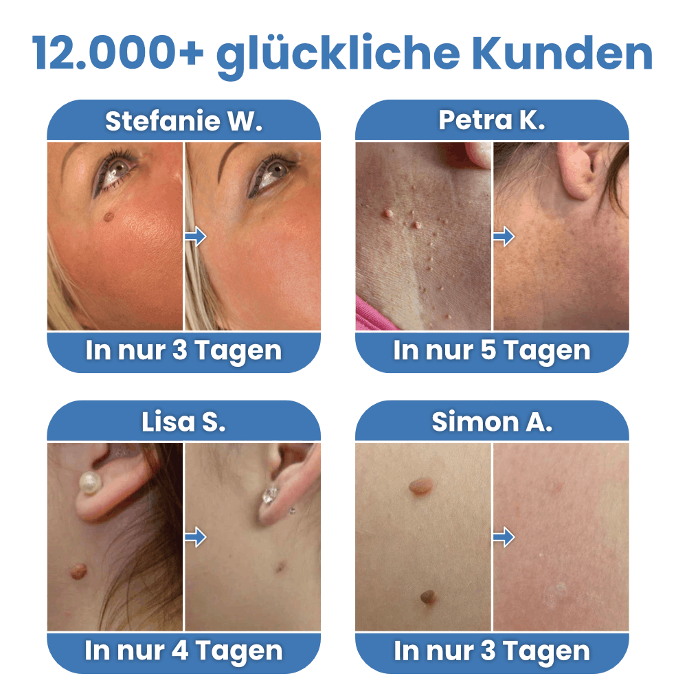 Warzenfrei - Der Stielwarzen Entferner
