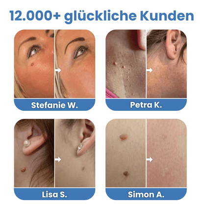 Warzenfrei - Der Stielwarzen Entferner