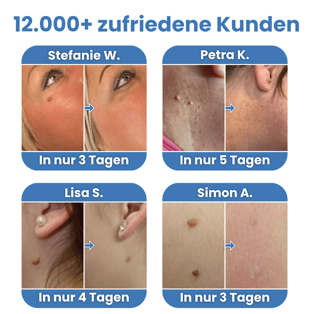Warzenfrei - Der Stielwarzen Entferner