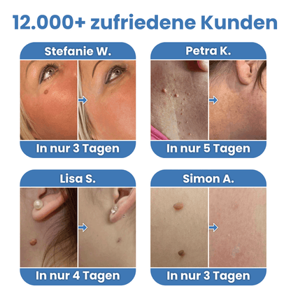 Warzenfrei - Der Stielwarzen Entferner