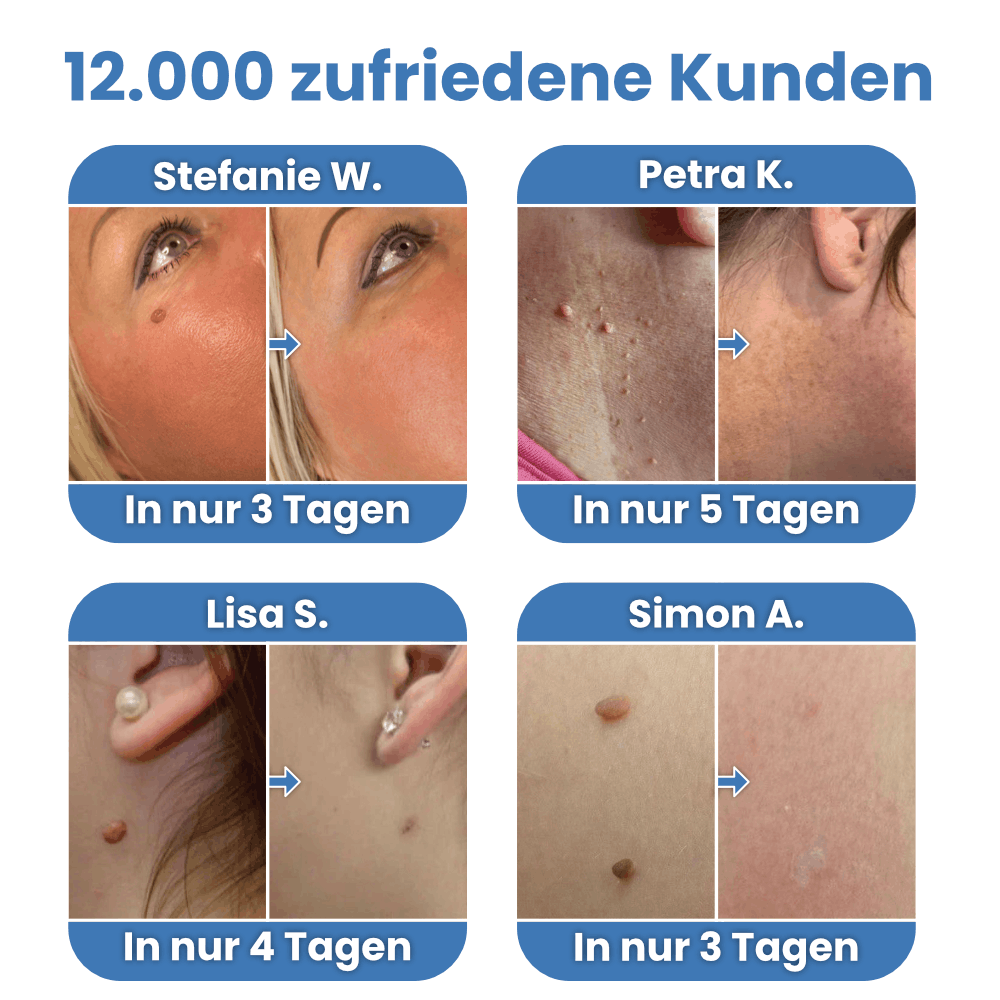 Warzenfrei - Der Stielwarzen Entferner