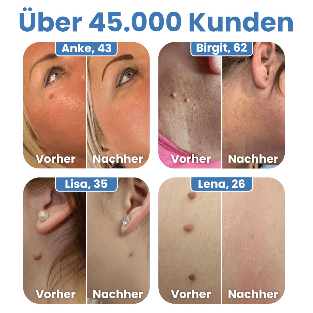 Warzenfrei - Der Stielwarzen Entferner