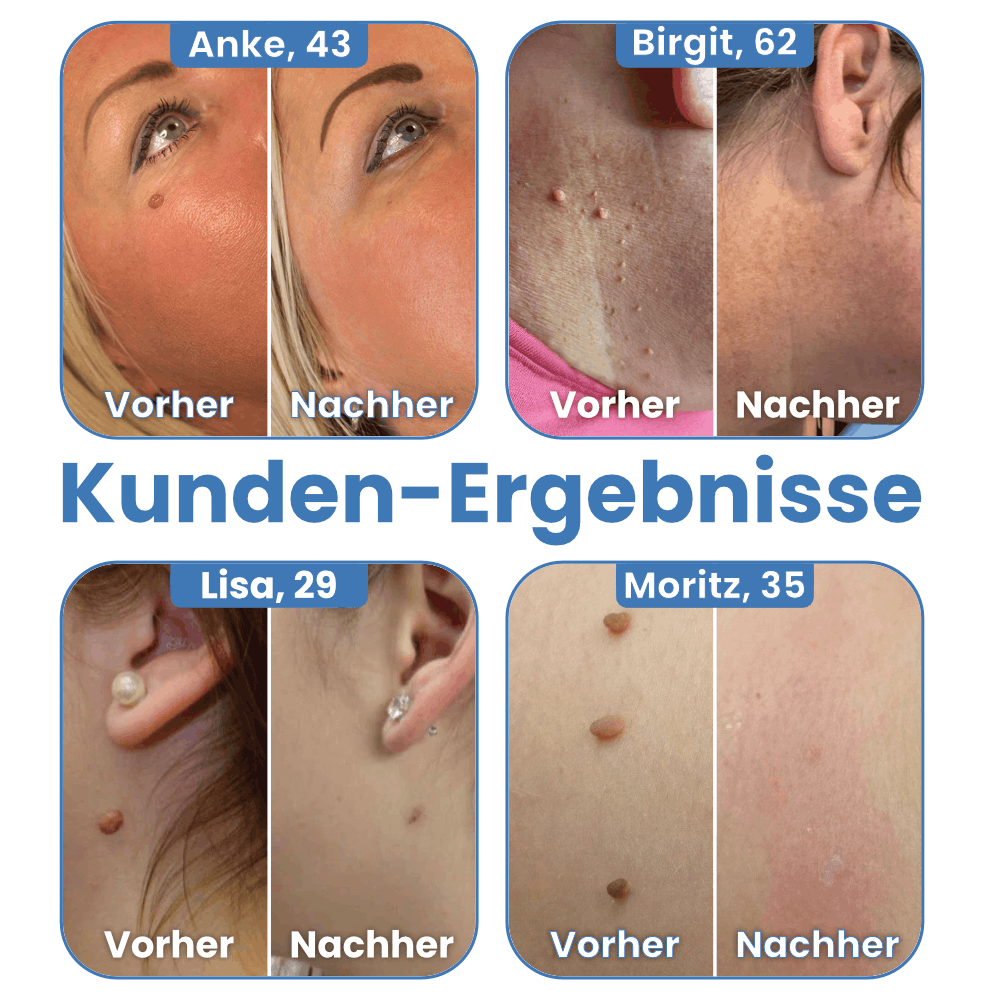 Warzenfrei - Der Stielwarzen Entferner