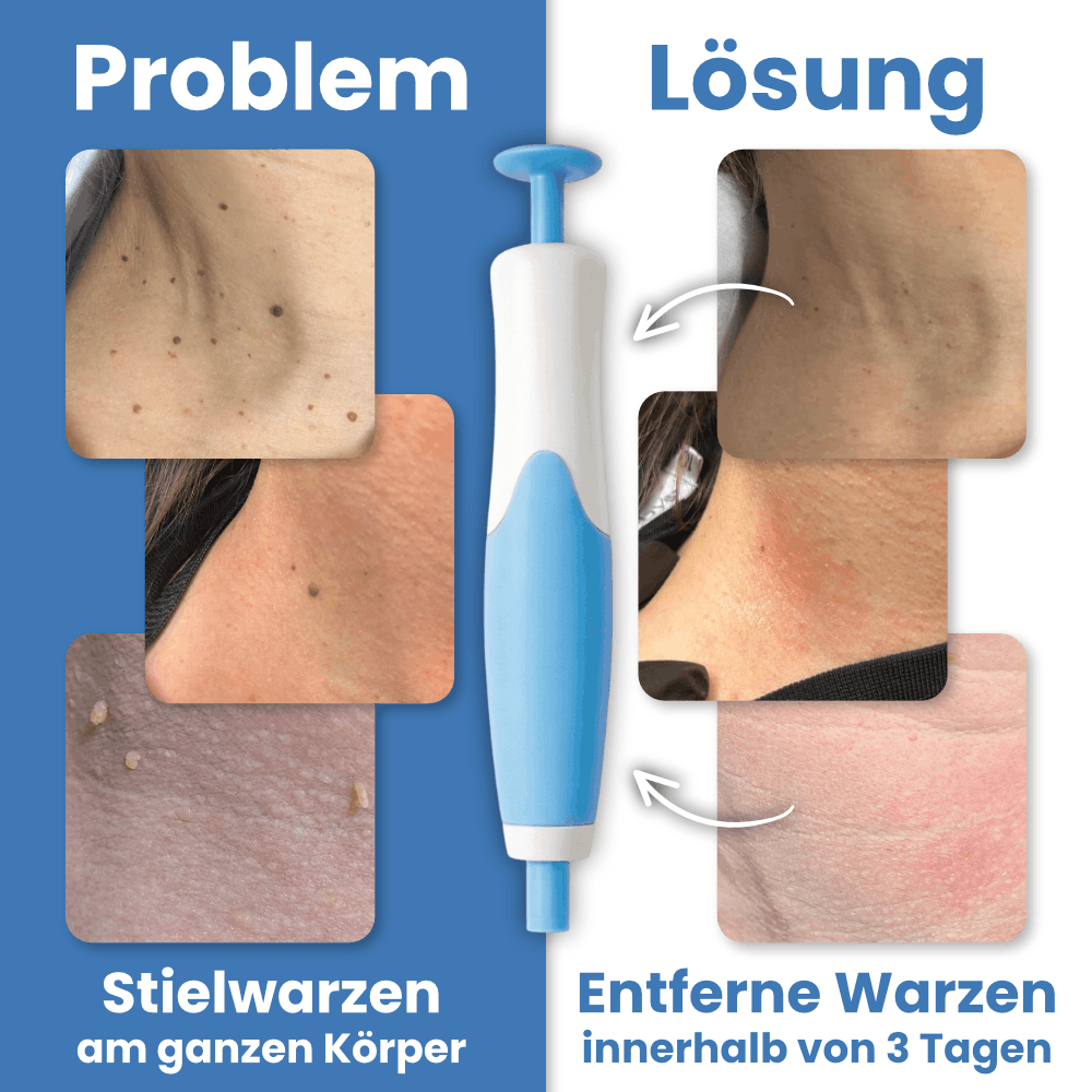 Warzenfrei - Der Stielwarzen Entferner