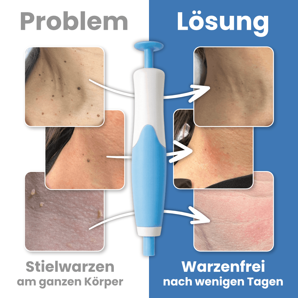 Warzenfrei - Der Stielwarzen Entferner