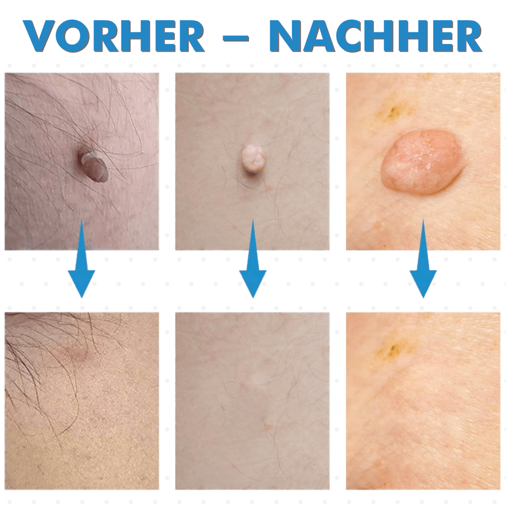 Warzenfrei - Der Stielwarzen Entferner