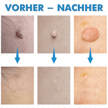 Warzenfrei - Der Stielwarzen Entferner