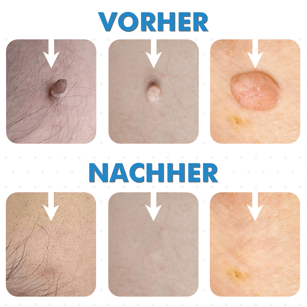 Warzenfrei - Der Stielwarzen Entferner