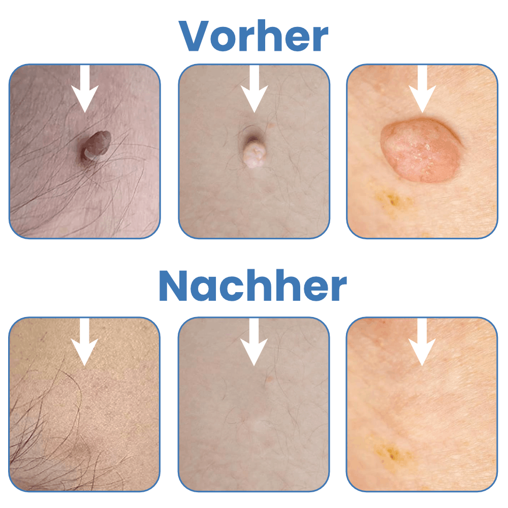 Warzenfrei - Der Stielwarzen Entferner