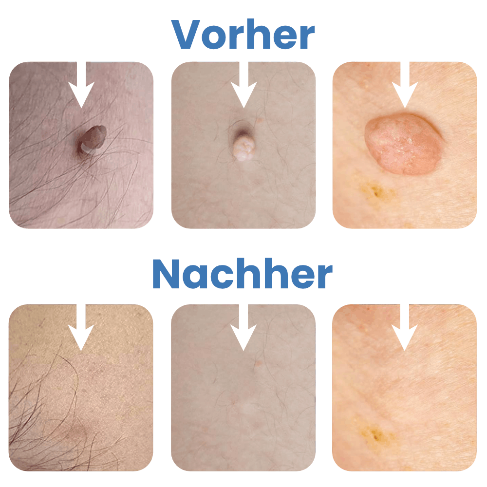 Warzenfrei - Der Stielwarzen Entferner