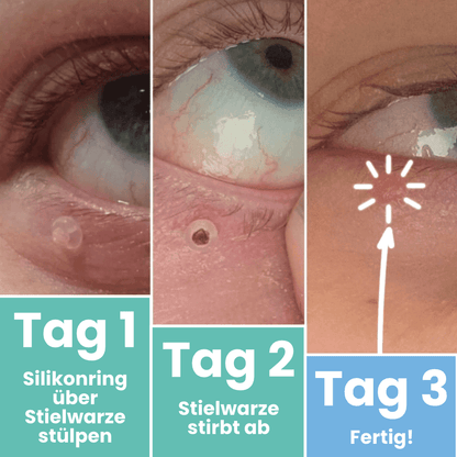 Warzenfrei PRO - Der Professionelle Stielwarzen Entferner