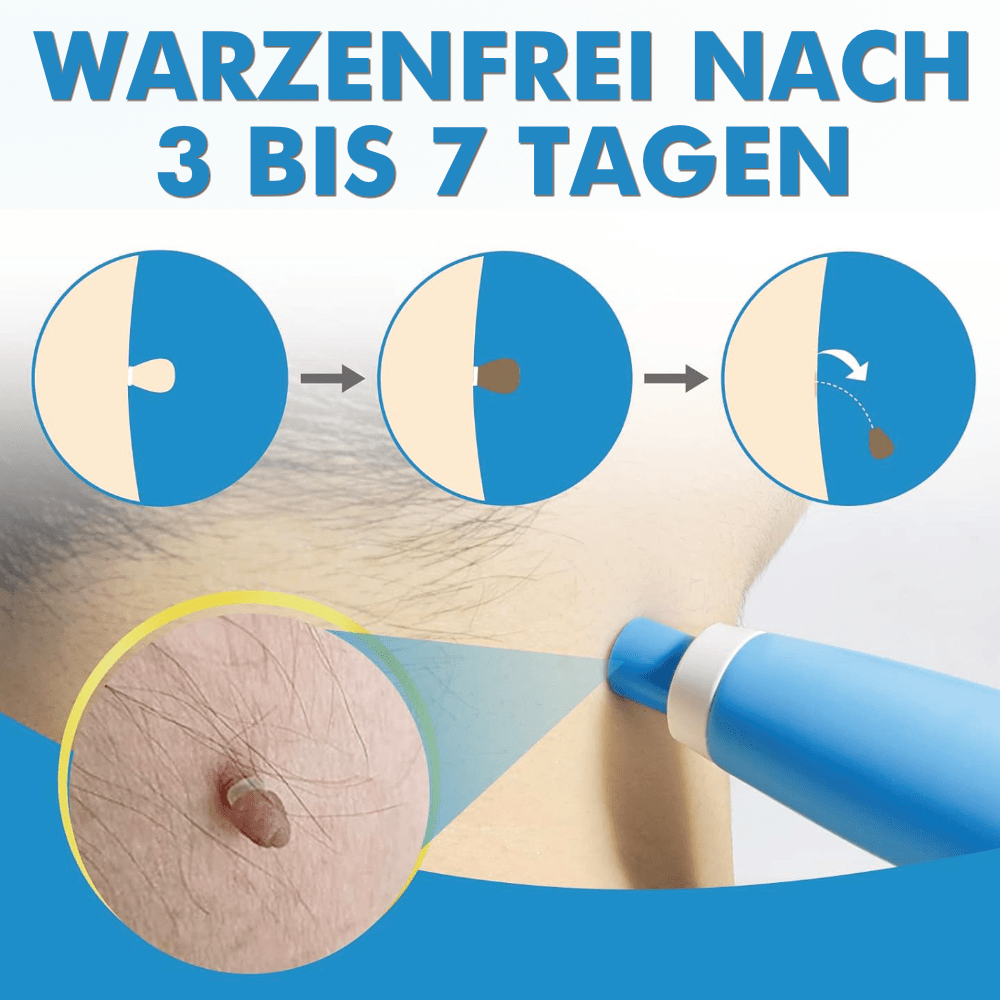 Warzenfrei - Der Stielwarzen Entferner